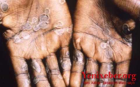 В Грузии зафиксирован первый случай заражения оспой обезьян