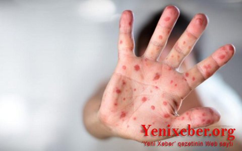 В Азербайджане разработан клинический протокол по диагностике и лечению вируса оспы обезьян