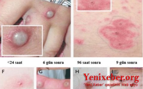 В Литве выявили первый случай заражения вирусом оспы обезьян