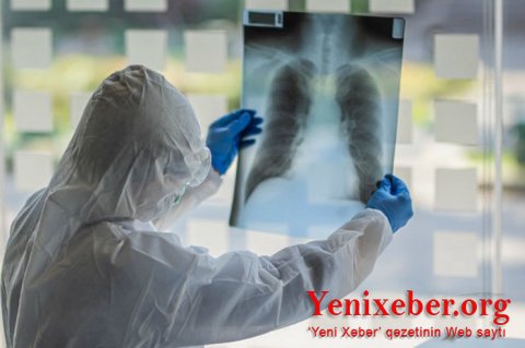 Pandemiya qurbanlarının sayı 516 mini keçib-