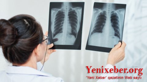 Dünyada bu günə olan yoluxma və ölüm sayı   -