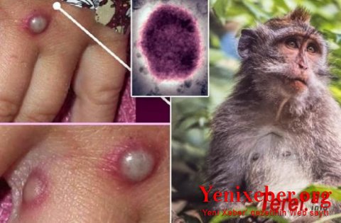 Bu ölkədə nadir virusa yoluxma aşkarlanıb-