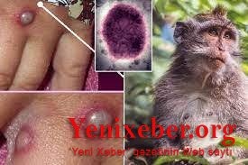 Bu ölkədə də meymunçiçəyi aşkarlandı