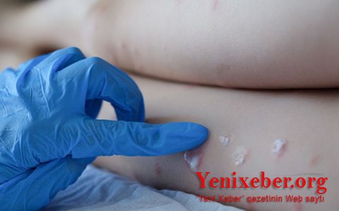 Meymunçiçəyinin sağalma müddəti və müalicədə istifadə olunan dərmanlar açıqlanıb